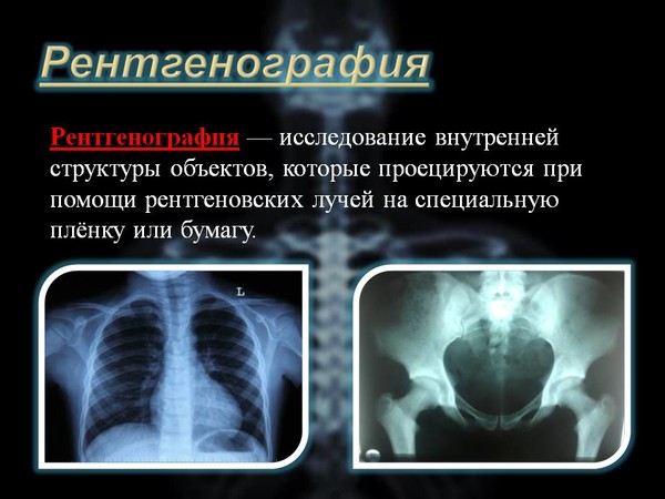 Рентген на дому Москва, Флюорография на дом Москва, Цифровой рентген на дому Москва, Травматолог на дом Москва, ЛОР на дом Москва , Стоматолог на дом, Нарколог на дом Москва, Психолог на дом, Невролог на дом, УЗИ на дому Москва, ЭКГ на дому Москва, Анализы на дому Москва, бесплатно по полису ДМС добровольное медицинское страхование. 
Балканская рамка - ( аренда и продажа) ; 
#рентгеннадому #рентгеннадомуМосква 
Рентген на дому Москва, Подмосковье, Московская область, Вороново, Красная Пахра, Дмитров, Сергеев Пасад, Орехово Зуево, Новые Ватутинки, Мытищи, Одинцово, Люберцы, Подольск, Троицк, Московский, Красногорск, Лобня, Видное, Новая Москва, Домодедово , Внуково, Красногорск , Дедовск, Истра, Клин, Чехов, Серпухов, 
#рентген_на_дому_шейки_бедра #флюорография_на_дом 
Московский рентген на дому, Рентген на дому Москва, Флюорография на дом Москва, Цифровой рентген на дому Москва, Травматолог на дом Москва, ЛОР на дом Москва , Стоматолог на дом, Нарколог на дом Москва, Психолог на дом, Невролог на дом, УЗИ на дому Москва, ЭКГ на дому Москва, Анализы на дому Москва, бесплатно по полису ДМС добровольное медицинское страхование. 
#Московский_рентген_Рентген_на_дому
ЭТОТ РЕЦЕПТ РЕАЛЬНО ВОЗОБНОВЛЯЕТ ФУНКЦИОНИРОВАНИЕ КОЛЕНЕЙ И СУСТАВОВ! 
к дальнейшим осложнениям, так что вам нужно сделать все возможное, чтобы предотвратить это. 
Следующий рецепт улучшает состояние костной ткани и восстанавливает нормальное функционирование суставов и коленей. 
Ингредиенты: 
1кг меда; 
10 чайных ложек семян льна; 
50 г семян тыквы; 
5 столовых ложек кунжута; 
3 столовые ложки изюма; 
50 г семян подсолнечника; 
50 г зерен пшеницы; 
Все, что вам нужно сделать, это объединить ингредиенты в большой миске, хорошо перемешать, до получения однородной массы. Затем перенесите содержимое в стеклянную банку. 
Применение: 
Принимайте, одну чайную ложку этого лекарства перед завтраком и обедом. Эта смесь не только укрепит ваши суставы и мышцы сердца, но также улучшит эластичность ваших связок и сухожилий. 
Если Вам понравилась эта статья, ПОДПИСЫВАЙТЕСЬ на нашу группу и Вы узнаете еще много полезных советов о том, как укрепить и поддержать свое здоровье простым способом, не покупая дорогих лекарств.
#рентген_в_москве, #рентген_легких, #перелом_шейки_бедра, #шейка_бедра, #сделать_рентген, #сделать_рентген_на_дому, #вызвать_врача, #вызвать_врача_на_дом, #врач_на_дом, #вызвать_травматолога, #травматолог_на_дом, #перелом_ребер, #вправить_вывих, #травматолог, #перелом, #травма #вывих, #флюорография, #флюорография_на_дому, #ушиб, #пневмония #функциональная_кровать #рама_балканского 
#рентгеннадому #рентгеннадомуМосква 
#Рама_Балканского 
#травматолог_на_дом_Москва 
#рентген_на_дому_шейки_бедра_Москва 
#рентген_на_дому_лёгкие_Москва 
#рентген_на_дому_позвоночника_Москва 
#рентген_на_дому_отзывы_Москва 
#сделать_рентген_на_дому_Москва 
#вызвать_рентген_на_дом_Москва 
#рентген_на_дому_тазобедренного_сустав 
#Московский_рентген_Рентген_на_дому_шейки_бедра